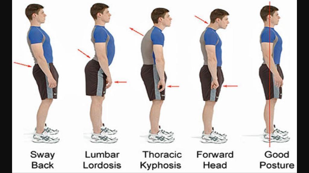 postural-assessment-physioexpert - Physio - Physical Therapy & Medical ...